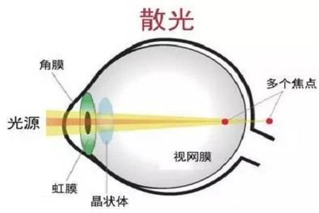 視力屈光不正是什么原因造成,視力屈光不正的原因解析與深層設計數據策略的探討——黃金版方案,全面評估解析說明_Premium36.58.94