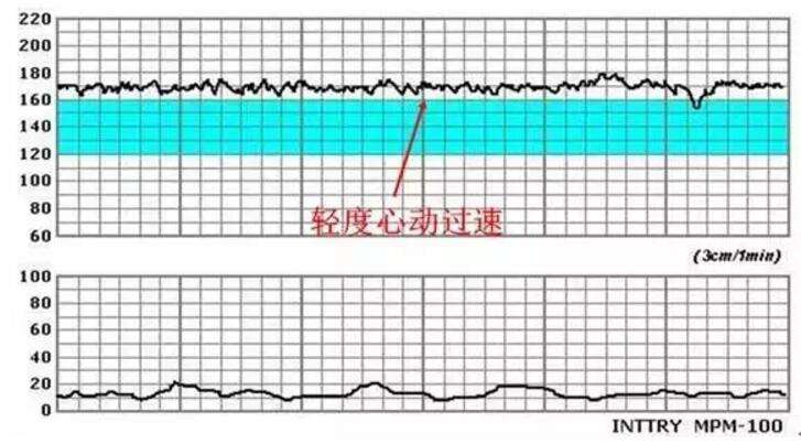 胎心監護圖怎么看正常,胎心監護圖解讀指南，如何判斷正常與進行精細評估,實地評估數據方案_Nexus20.35.80