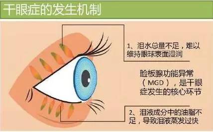 干眼癥的治療方法有哪些,干眼癥的治療方法有哪些，理論解答、解釋定義及應對之策,真實解答解釋定義_投版26.70.73