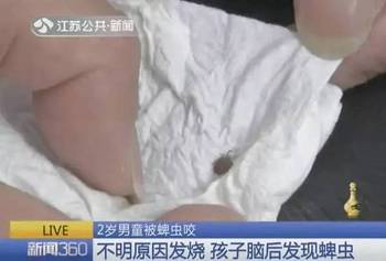 2歲男童發燒確診甲狀腺結節4級