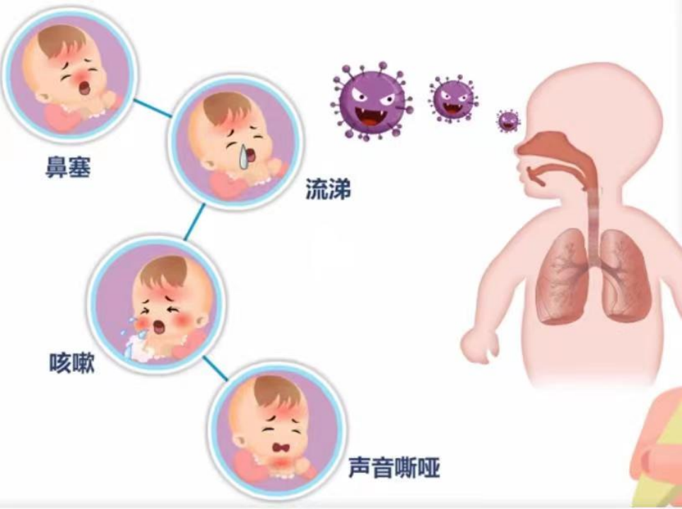 3歲女童同時感染3種呼吸道病毒